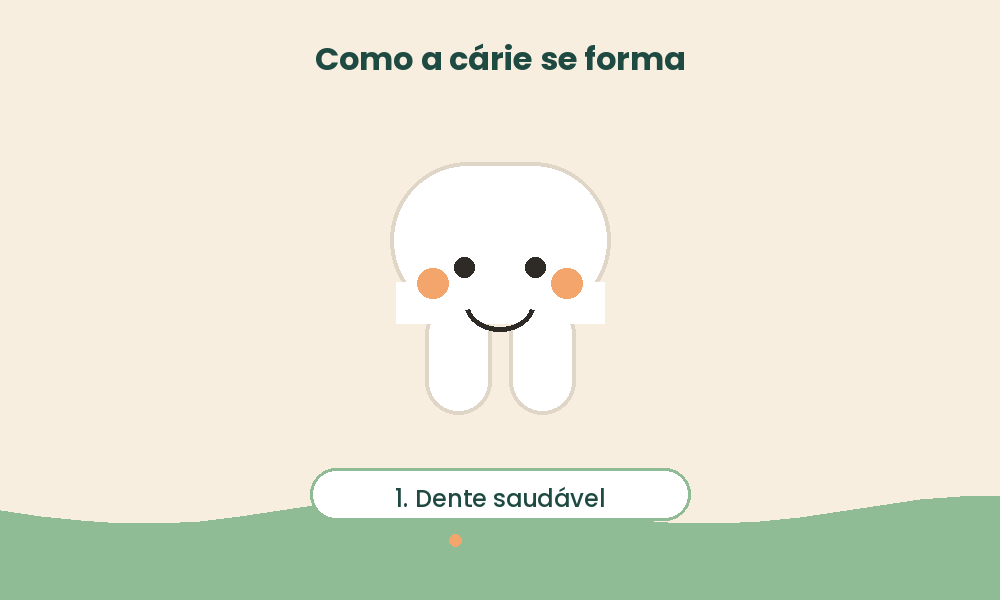 Animação mostrando como a cárie se forma nos dentes: bactérias, açúcar, ácido e desmineralização do esmalte em 4 estágios